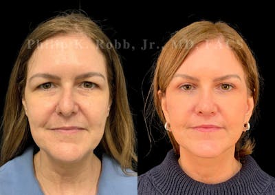 The Robb Refresh Before & After Gallery - Patient 301601 - Image 1