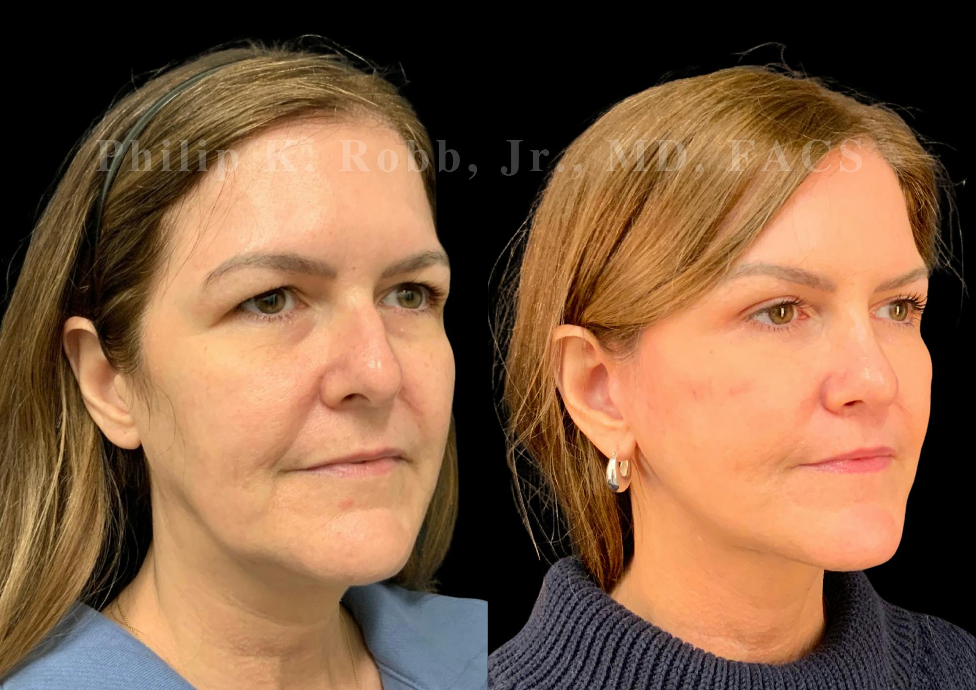 The Robb Refresh Before & After Gallery - Patient 301601 - Image 5