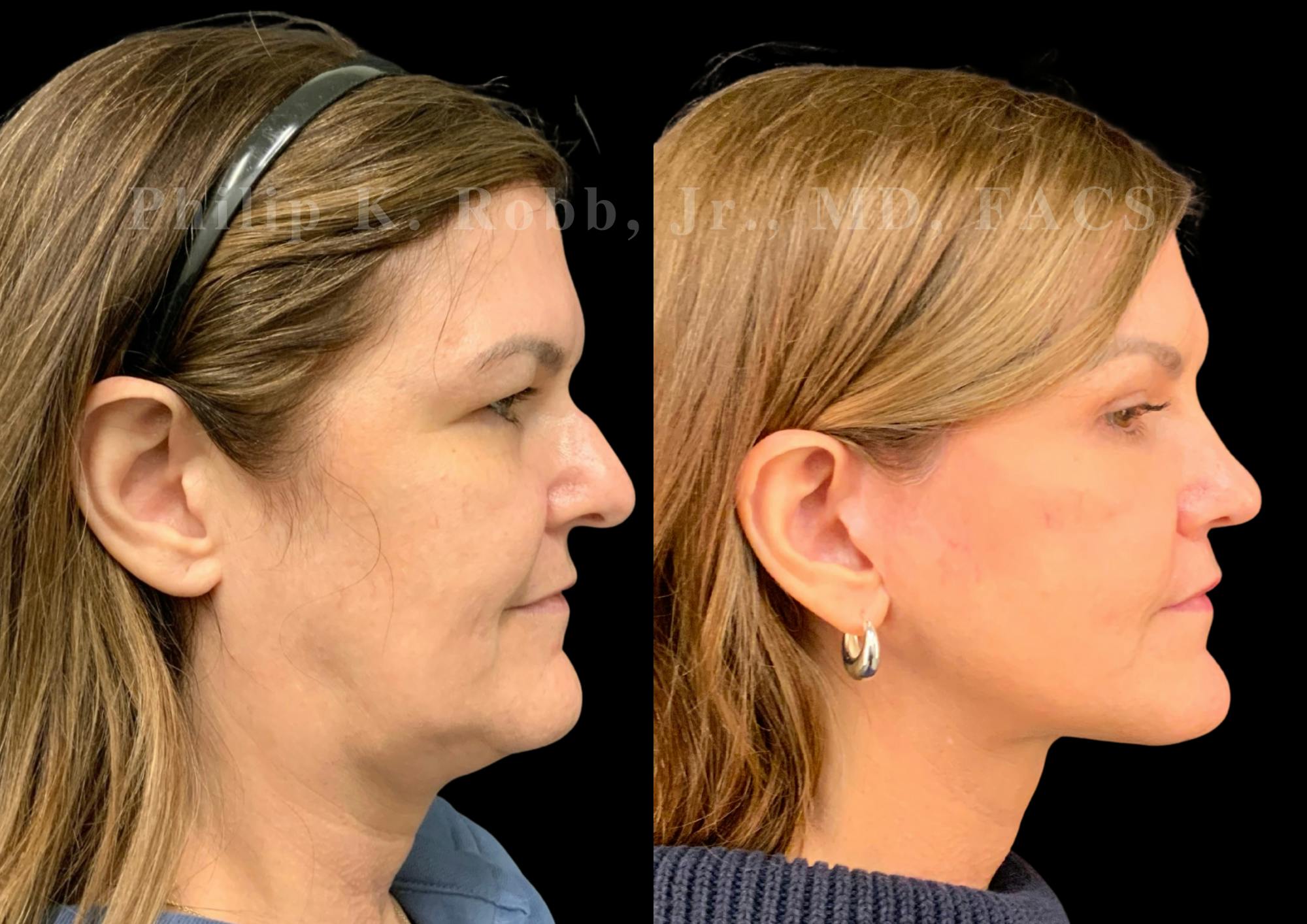 The Robb Refresh Before & After Gallery - Patient 301601 - Image 6