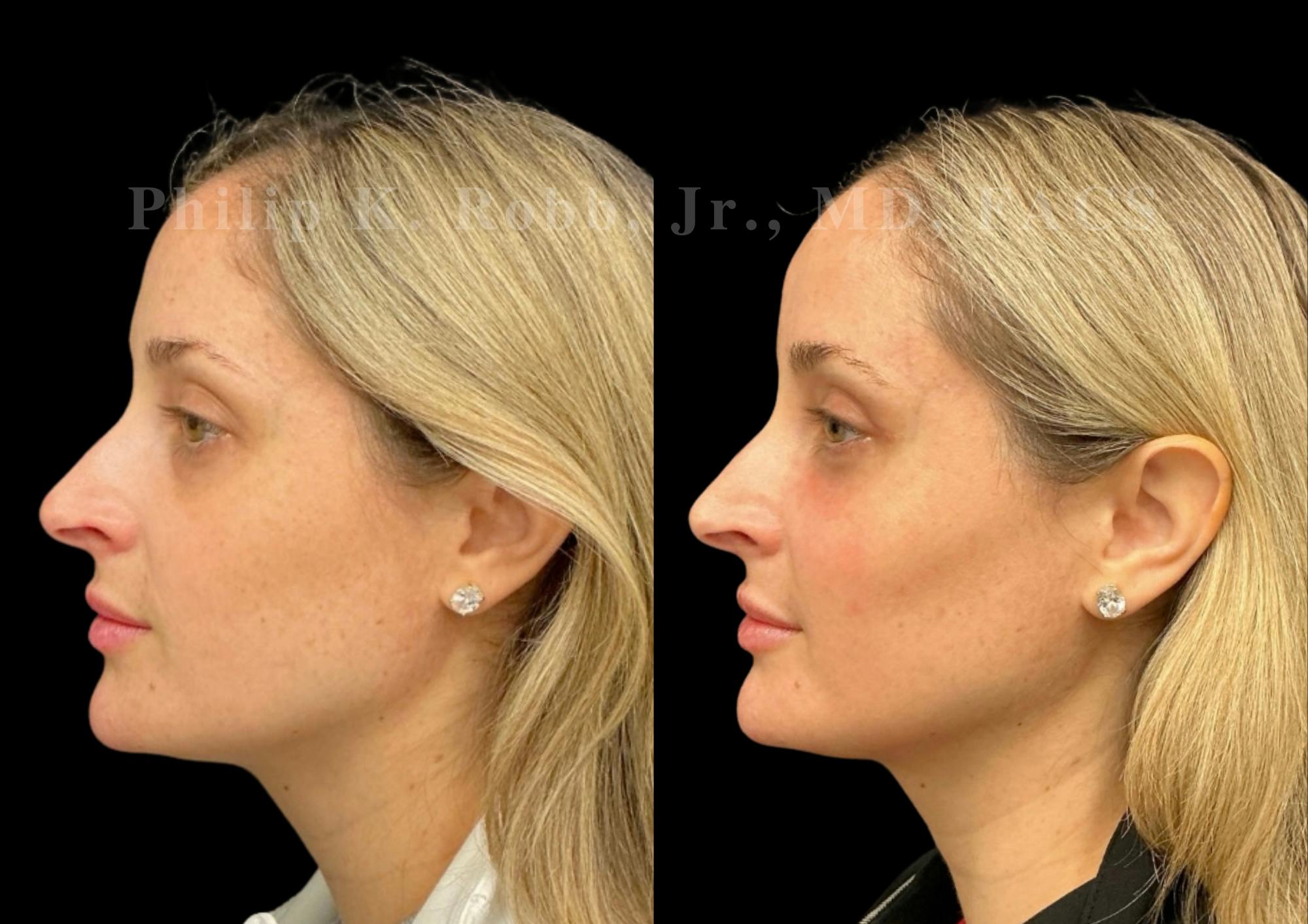 Laser Skin Resurfacing Before & After Gallery - Patient 387807 - Image 2