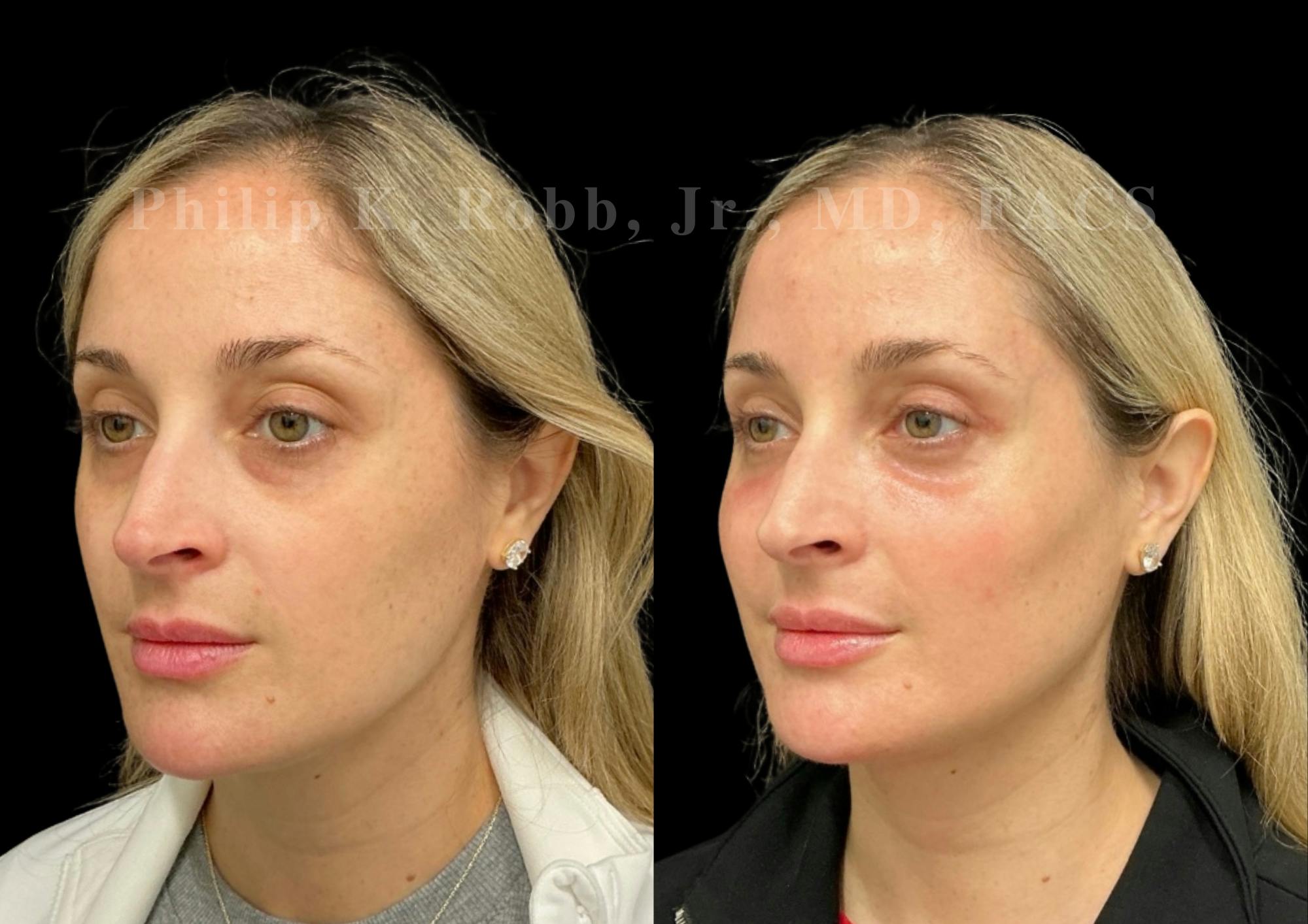 Laser Skin Resurfacing Before & After Gallery - Patient 387807 - Image 4