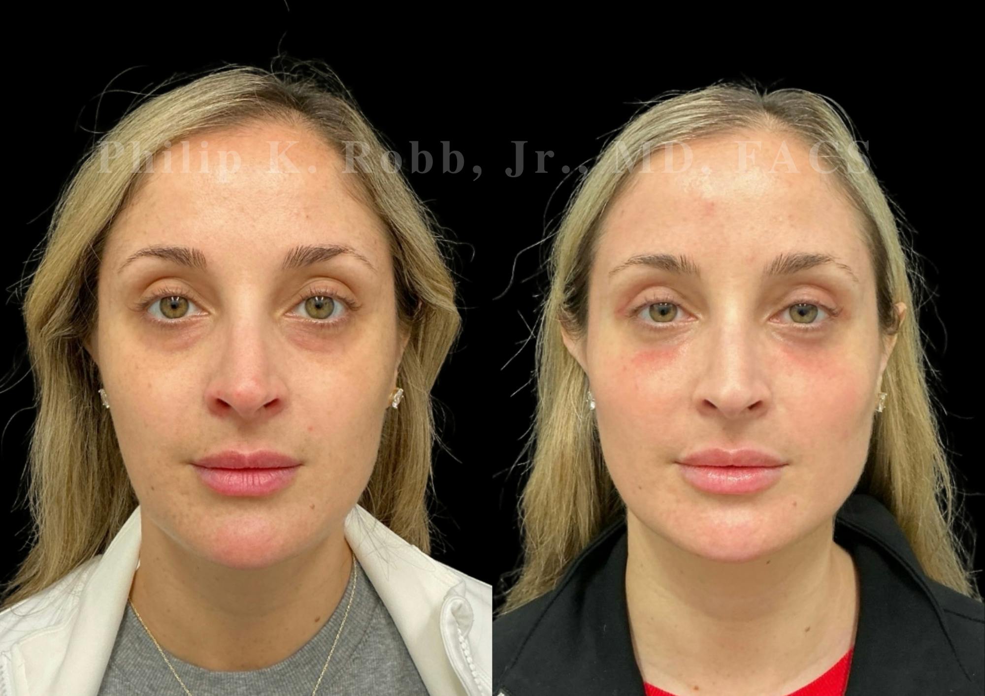 Laser Skin Resurfacing Before & After Gallery - Patient 387807 - Image 1