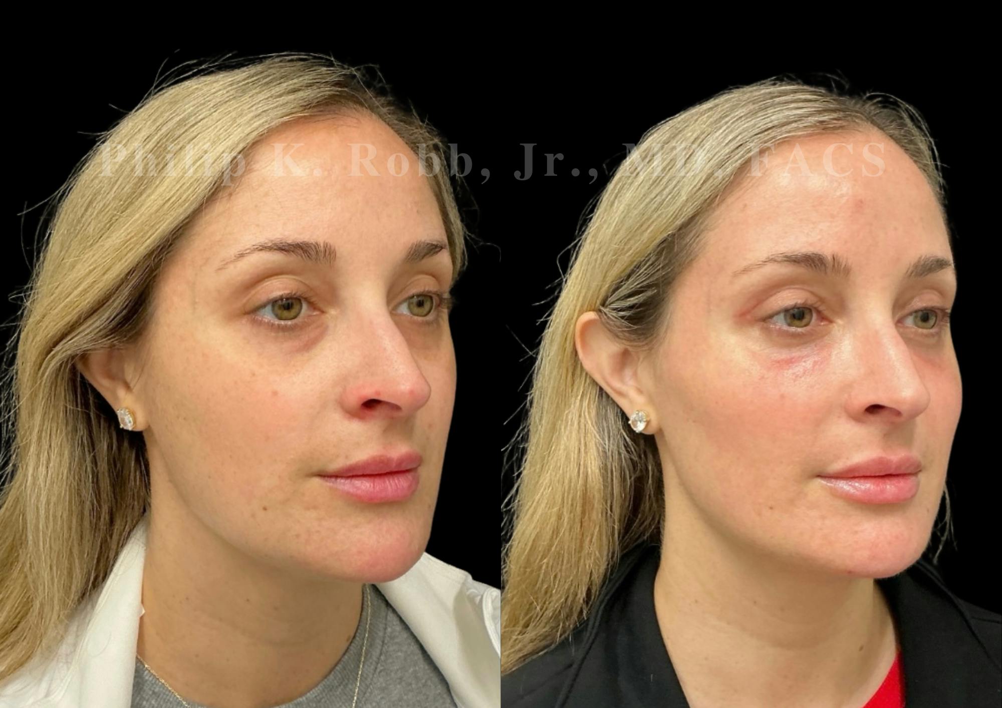 Laser Skin Resurfacing Before & After Gallery - Patient 387807 - Image 3
