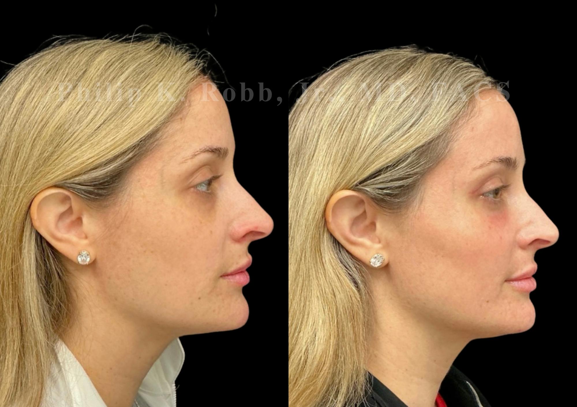 Laser Skin Resurfacing Before & After Gallery - Patient 387807 - Image 5