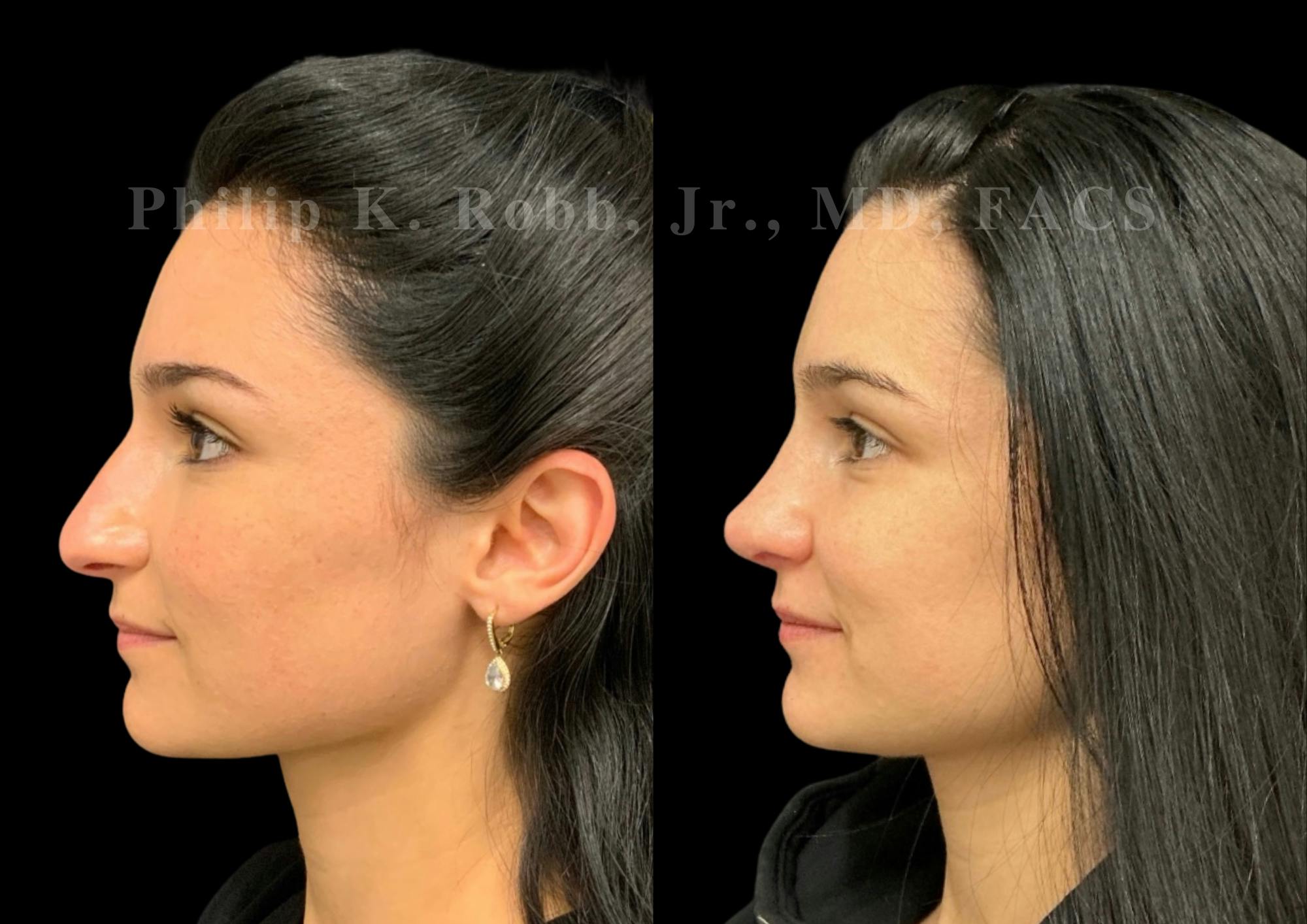 Ultrasonic Rhinoplasty Before & After Gallery - Patient 142984 - Image 2