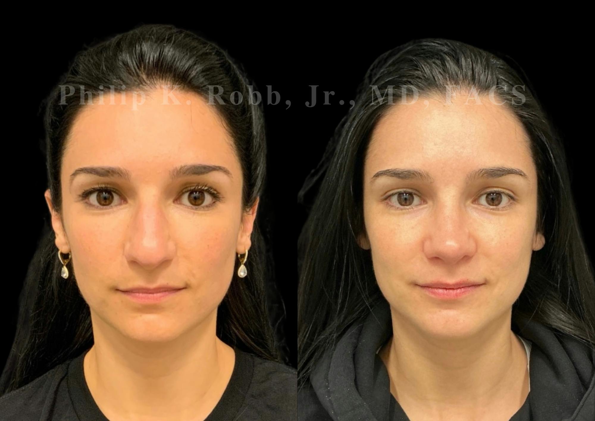 Ultrasonic Rhinoplasty Before & After Gallery - Patient 142984 - Image 4