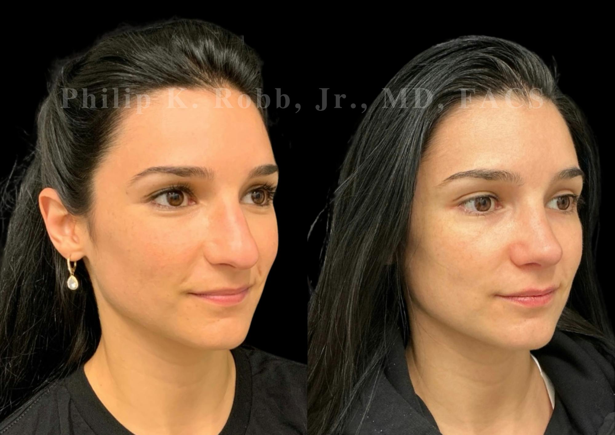 Ultrasonic Rhinoplasty Before & After Gallery - Patient 142984 - Image 5