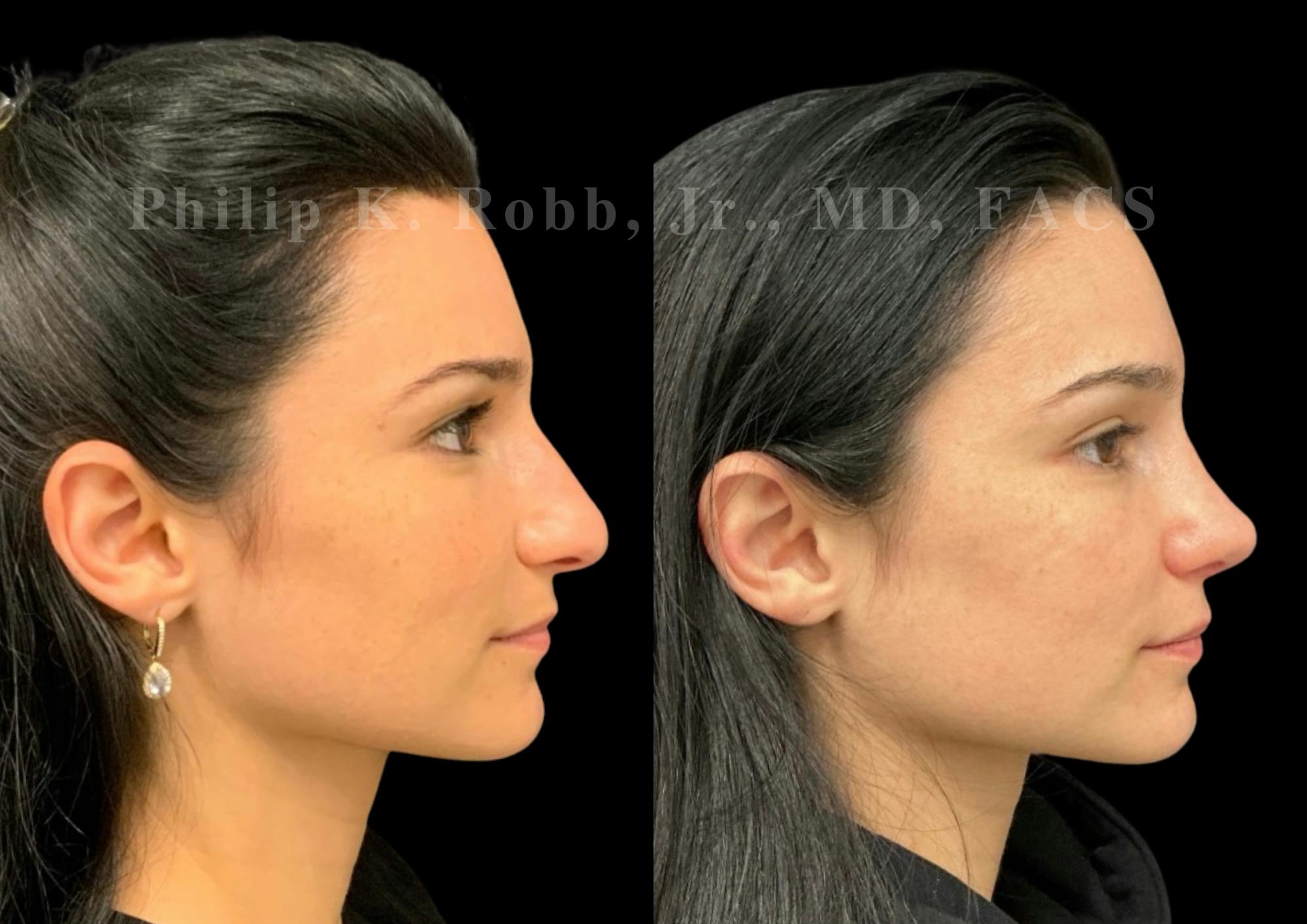 Ultrasonic Rhinoplasty Before & After Gallery - Patient 142984 - Image 1