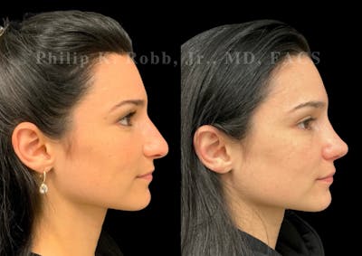 Ultrasonic Rhinoplasty Before & After Gallery - Patient 142984 - Image 1