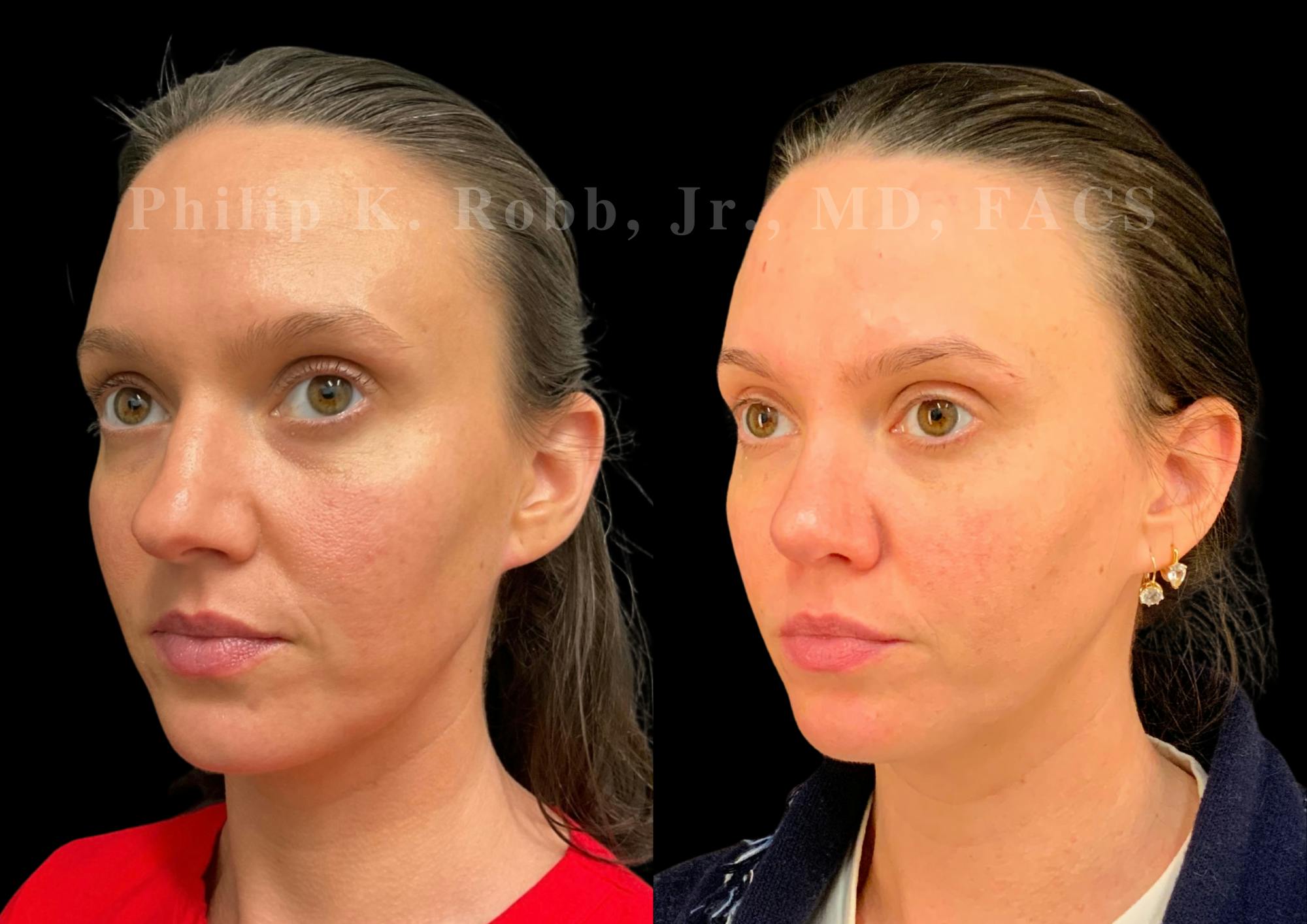 Ultrasonic Rhinoplasty Before & After Gallery - Patient 155149 - Image 3