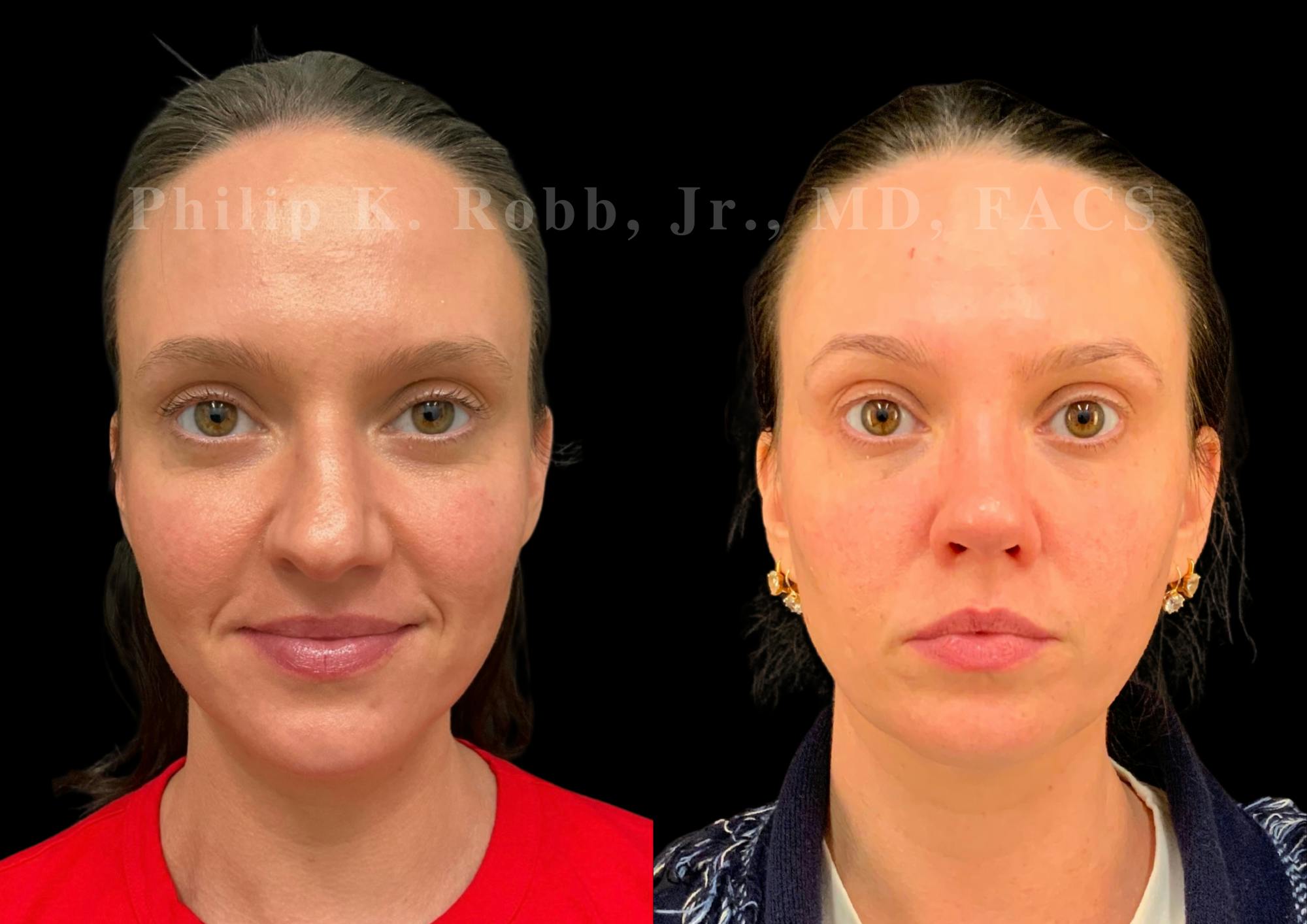 Ultrasonic Rhinoplasty Before & After Gallery - Patient 155149 - Image 4
