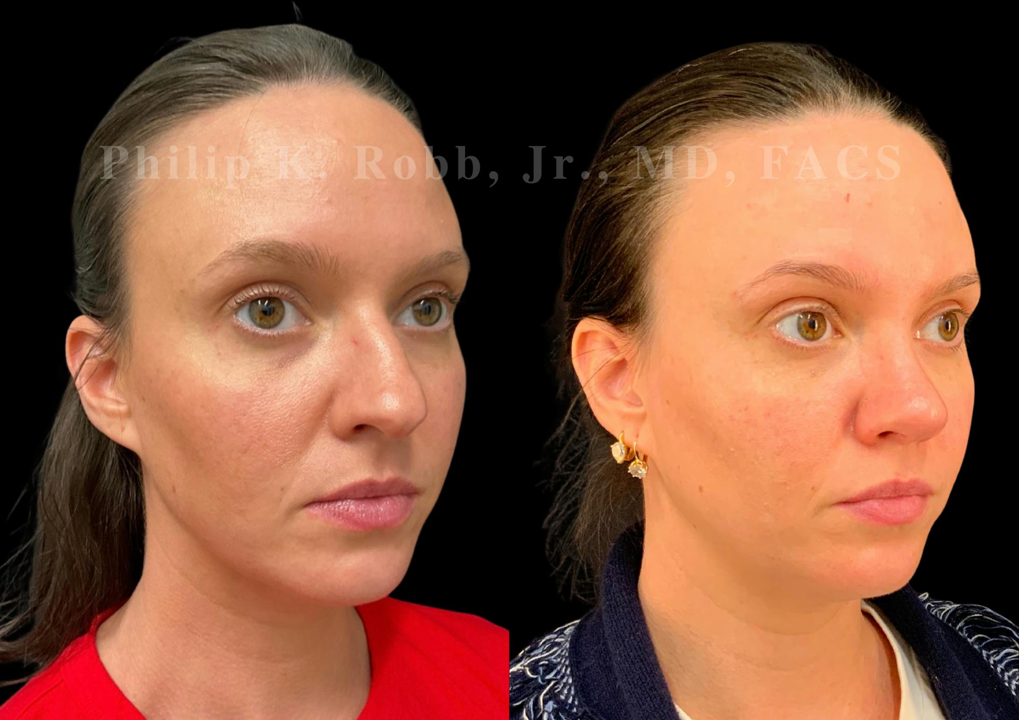Ultrasonic Rhinoplasty Before & After Gallery - Patient 155149 - Image 5