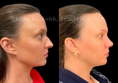 Ultrasonic Rhinoplasty Before & After Gallery - Patient 155149 - Image 1
