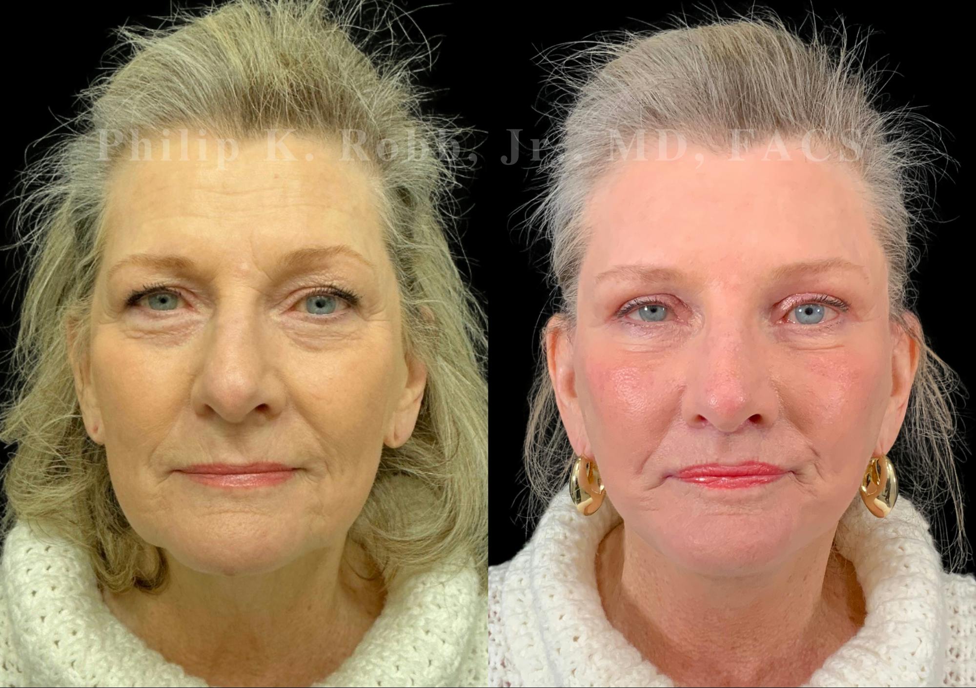 The Robb Refresh Before & After Gallery - Patient 388722 - Image 1