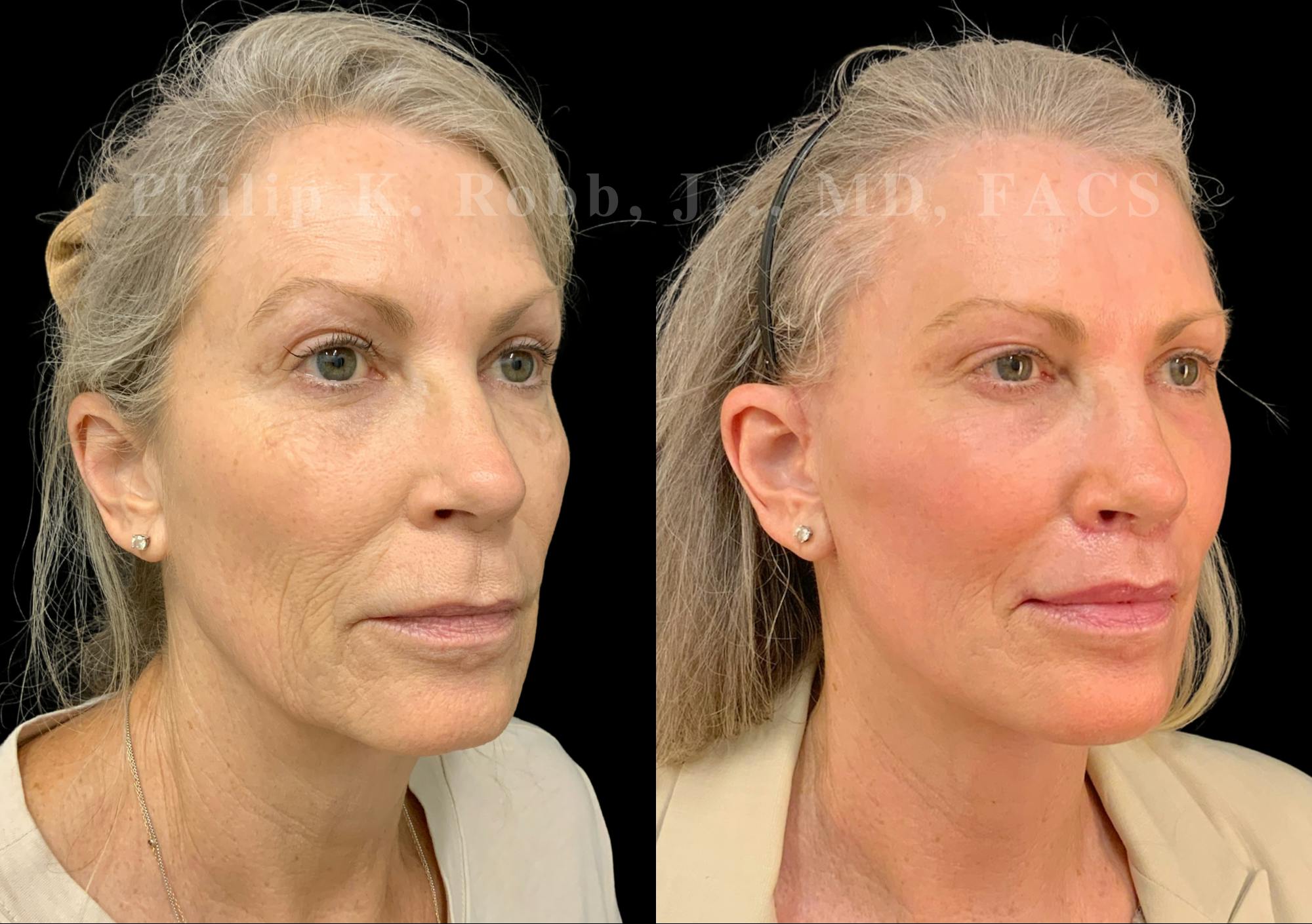 The Robb Refresh Before & After Gallery - Patient 218990 - Image 1