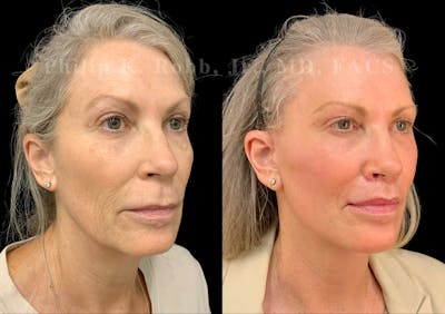 The Robb Refresh Before & After Gallery - Patient 218990 - Image 1