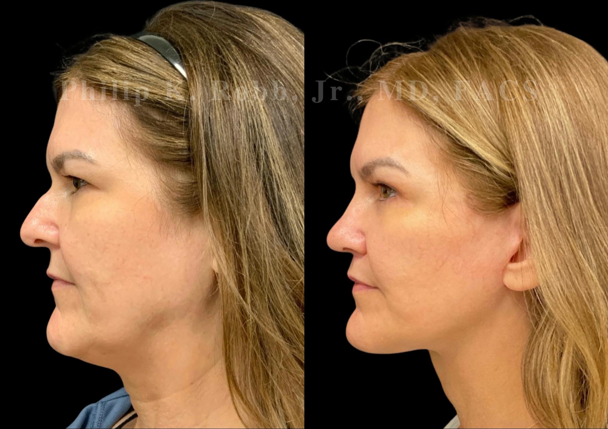 The Robb Refresh Before & After Gallery - Patient 402050 - Image 1