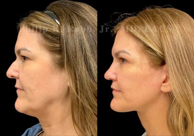 The Robb Refresh Before & After Gallery - Patient 402050 - Image 1