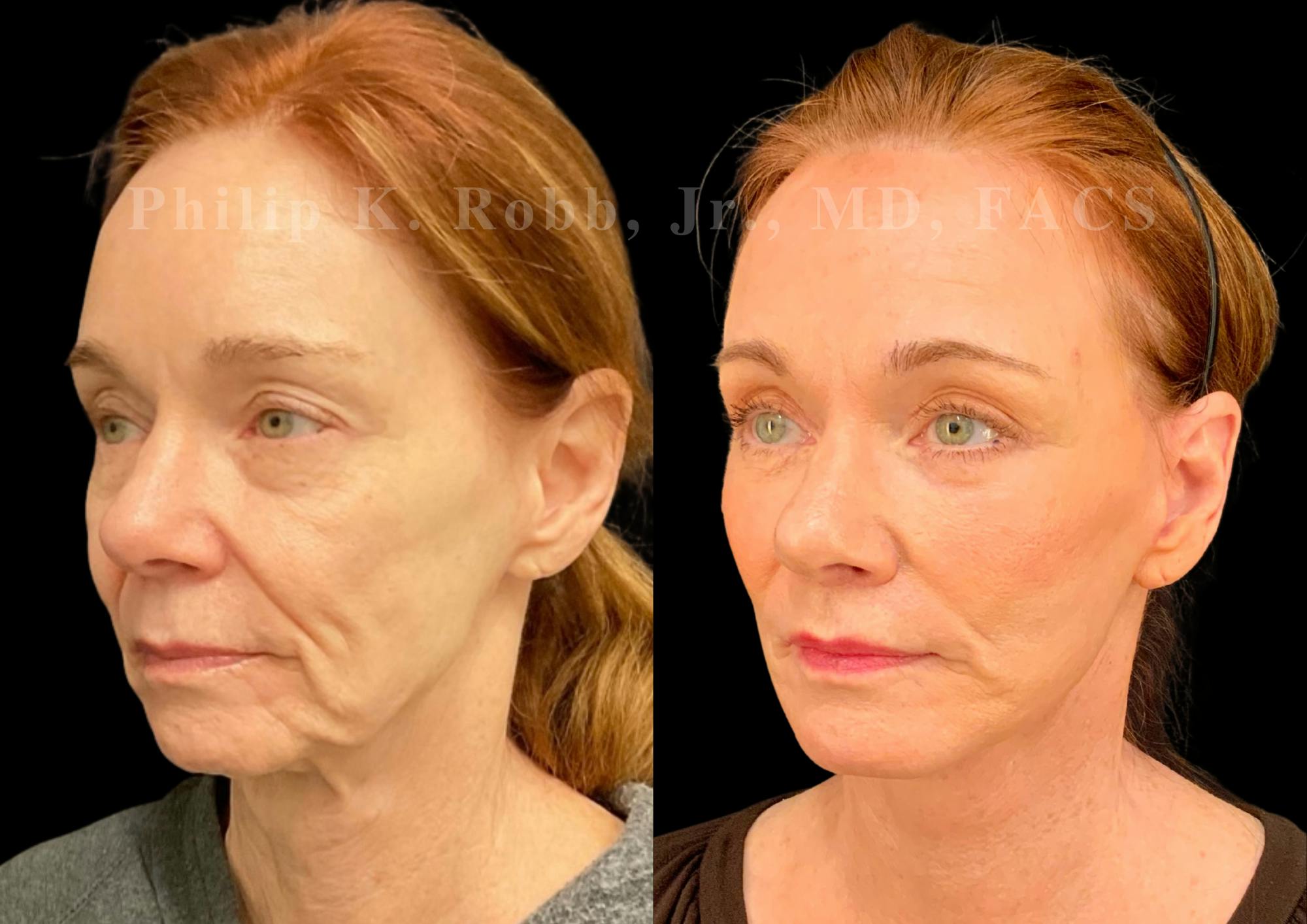 The Robb Refresh Before & After Gallery - Patient 272130 - Image 1