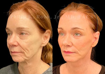 The Robb Refresh Before & After Gallery - Patient 272130 - Image 1