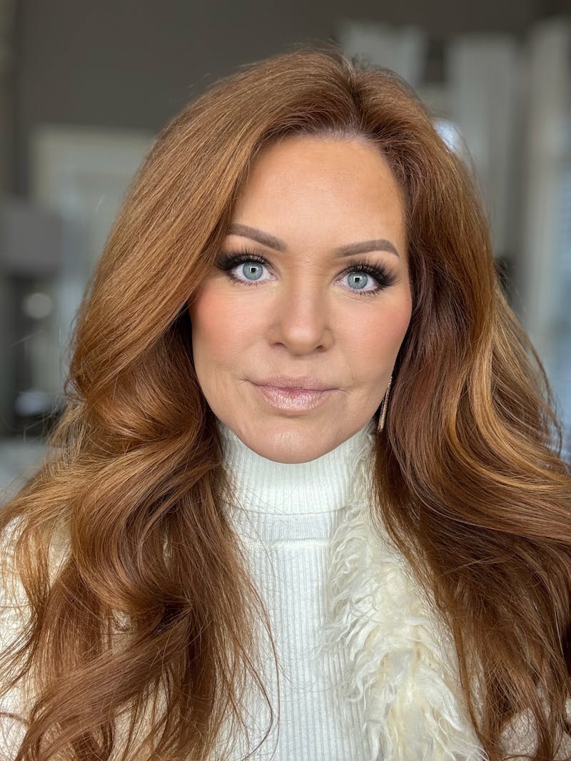 The Robb Refresh Before & After Gallery - Patient 282816 - Image 1