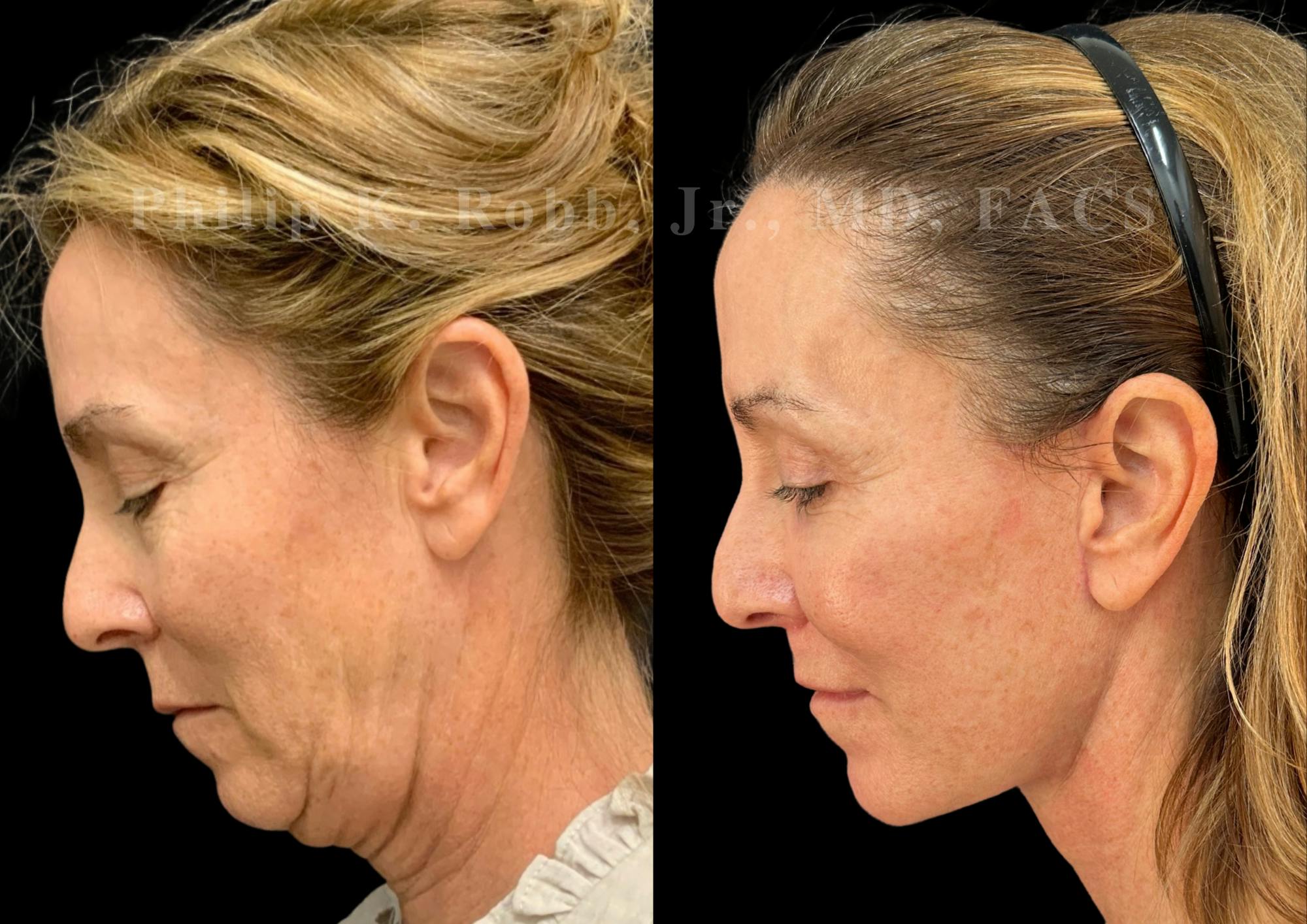 The Robb Refresh Before & After Gallery - Patient 157812 - Image 1