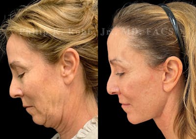 The Robb Refresh Before & After Gallery - Patient 157812 - Image 1