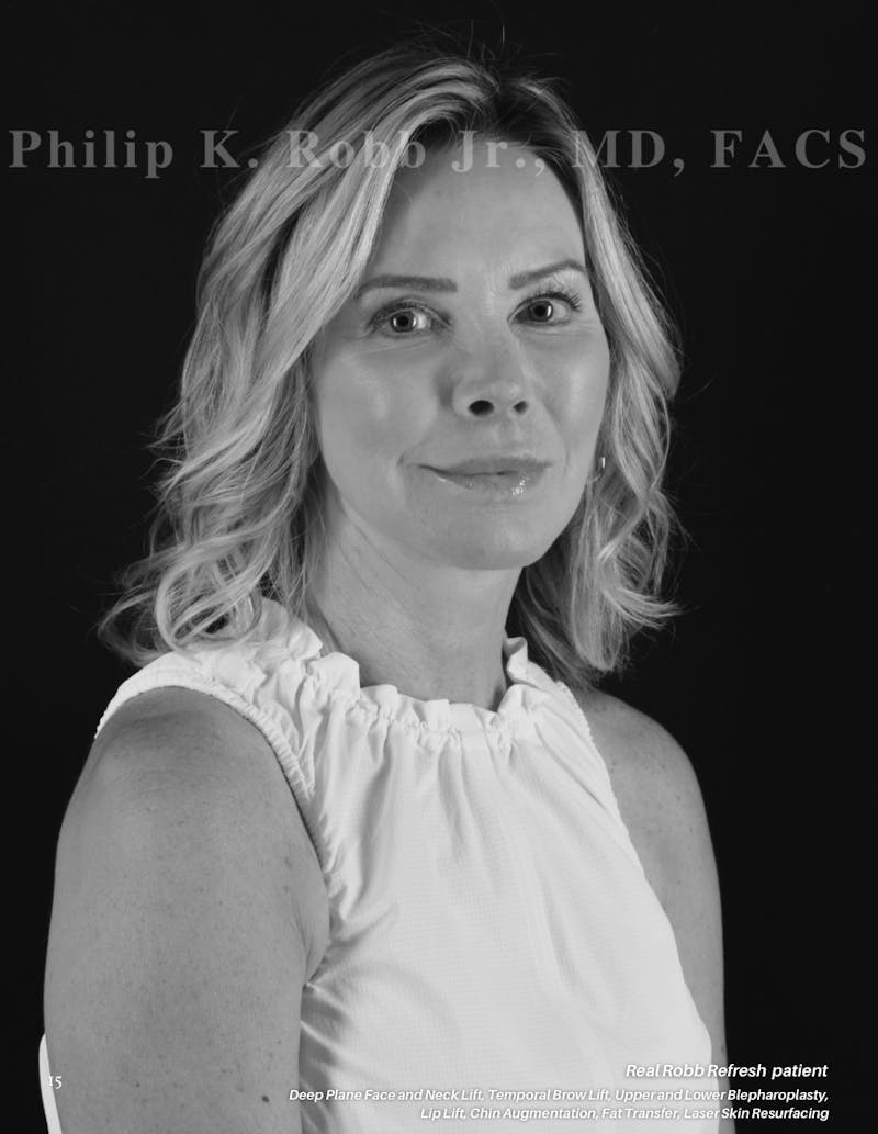 The Robb Refresh Before & After Gallery - Patient 251062 - Image 1