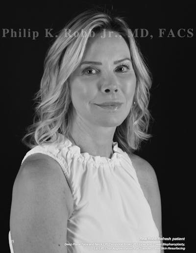 The Robb Refresh Before & After Gallery - Patient 251062 - Image 1