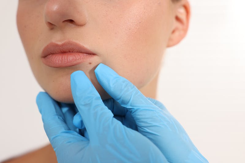 woman with mole on face