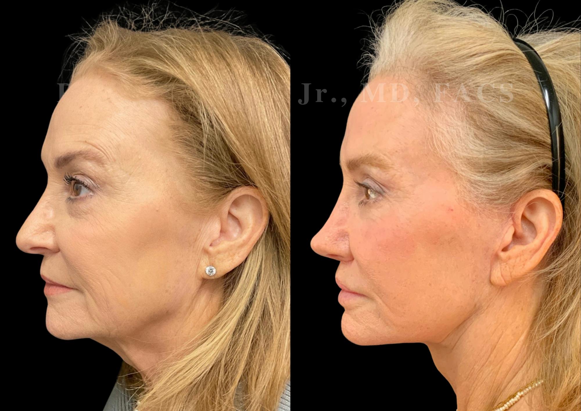 Fat Transfer Before & After Gallery - Patient 267906 - Image 2