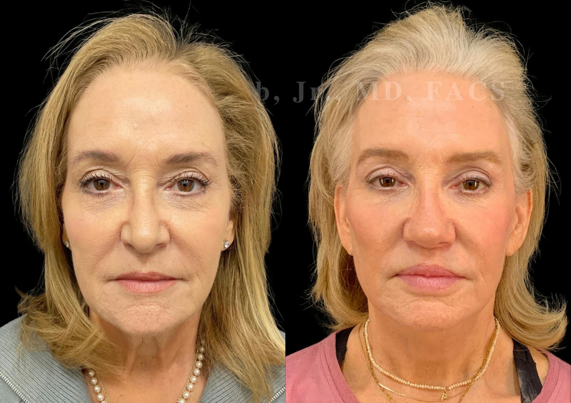 Fat Transfer Before & After Gallery - Patient 267906 - Image 1