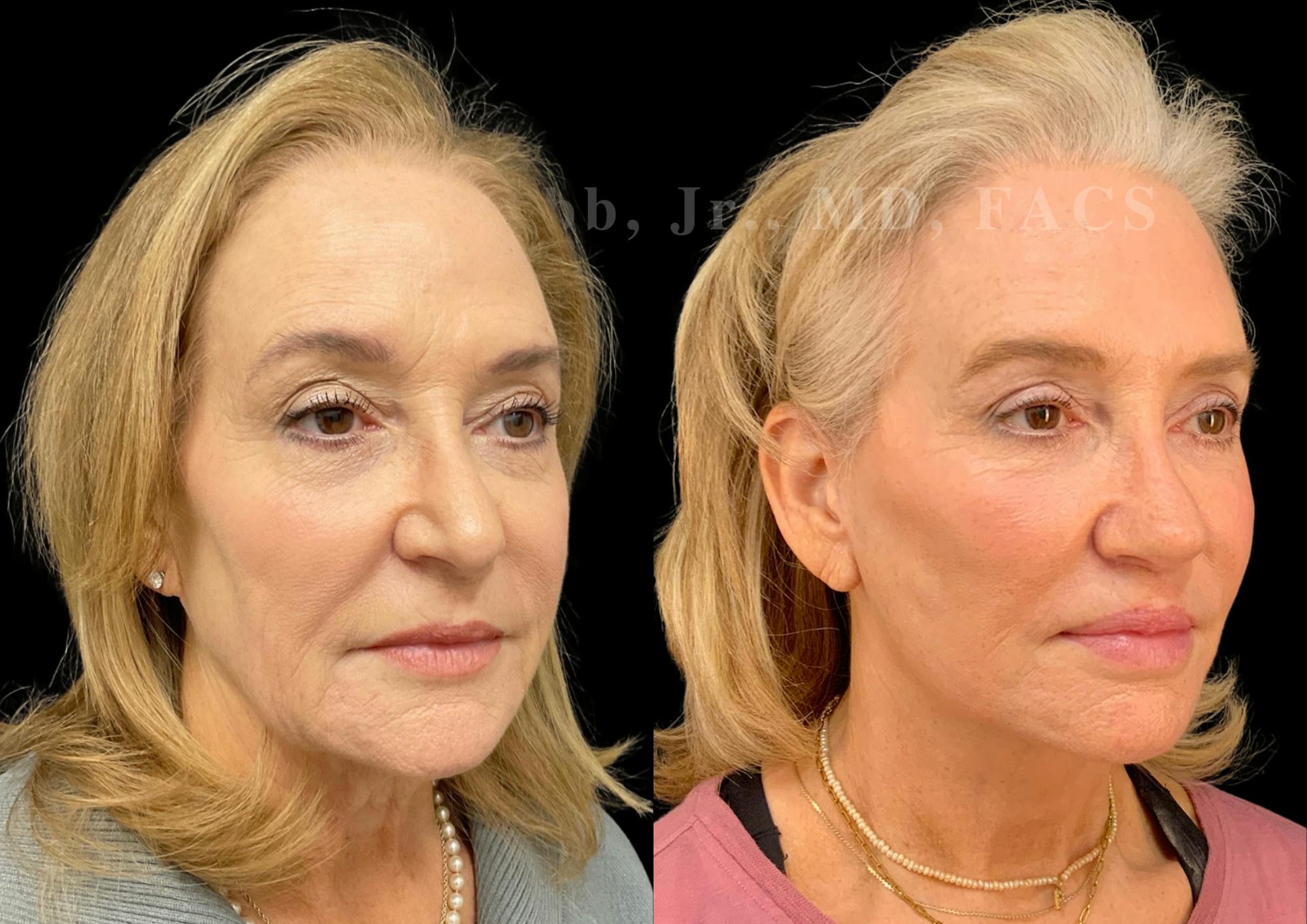 Fat Transfer Before & After Gallery - Patient 267906 - Image 4