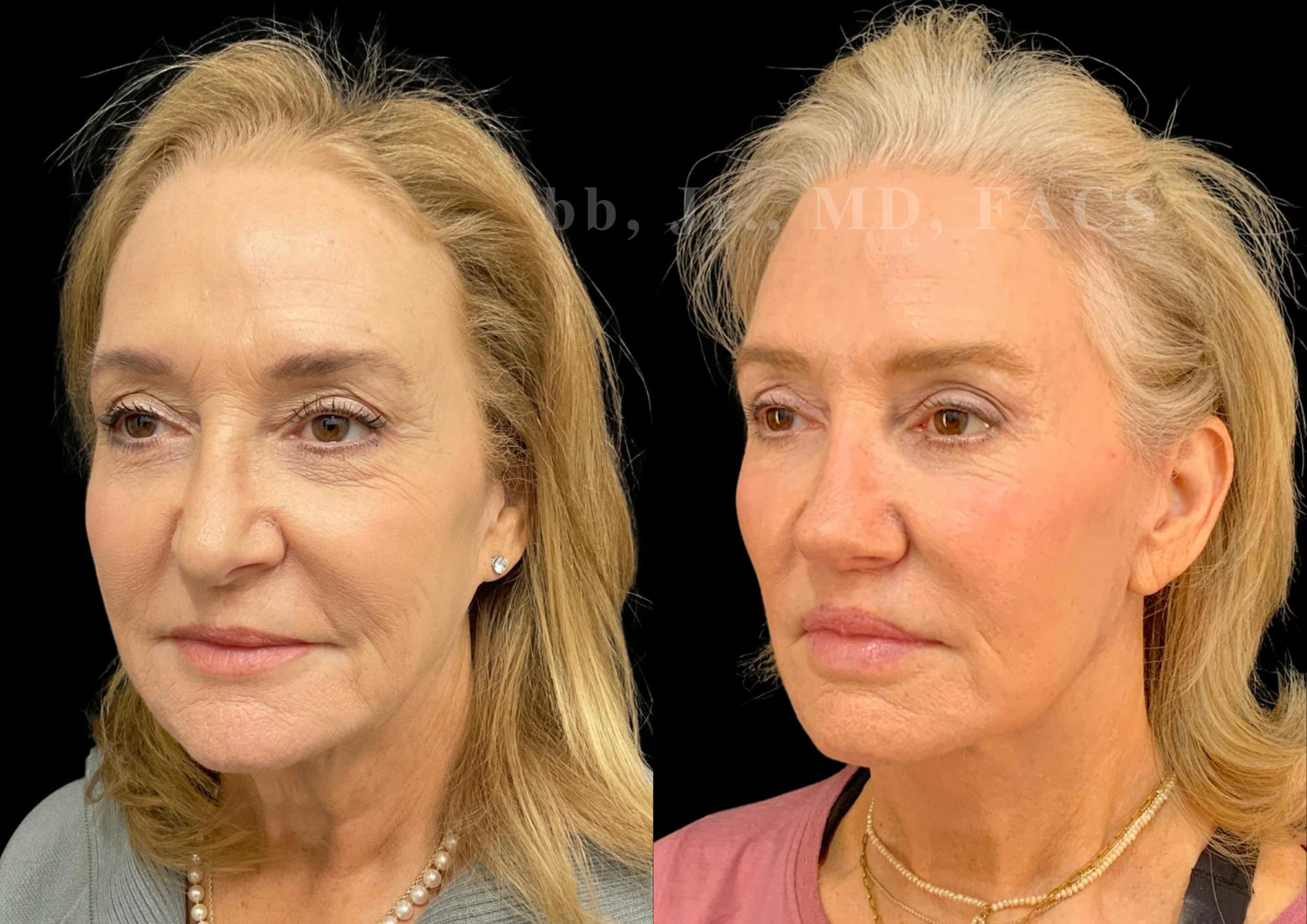 Fat Transfer Before & After Gallery - Patient 267906 - Image 3
