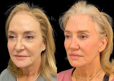 Facelift Before & After Gallery - Patient 184737 - Image 1