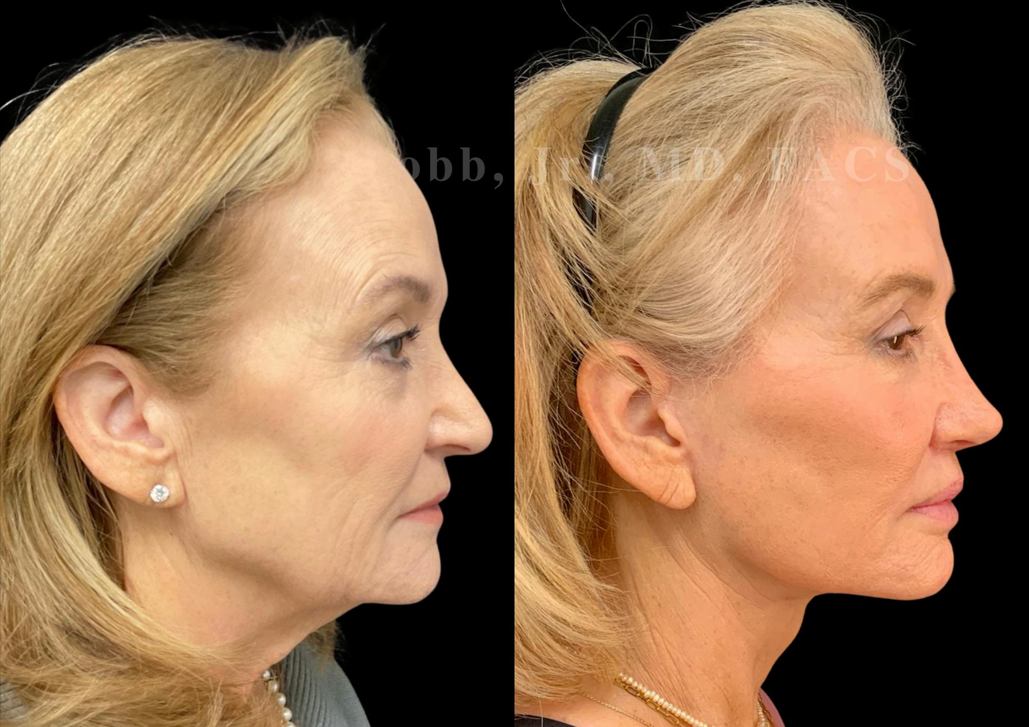 Fat Transfer Before & After Gallery - Patient 267906 - Image 5