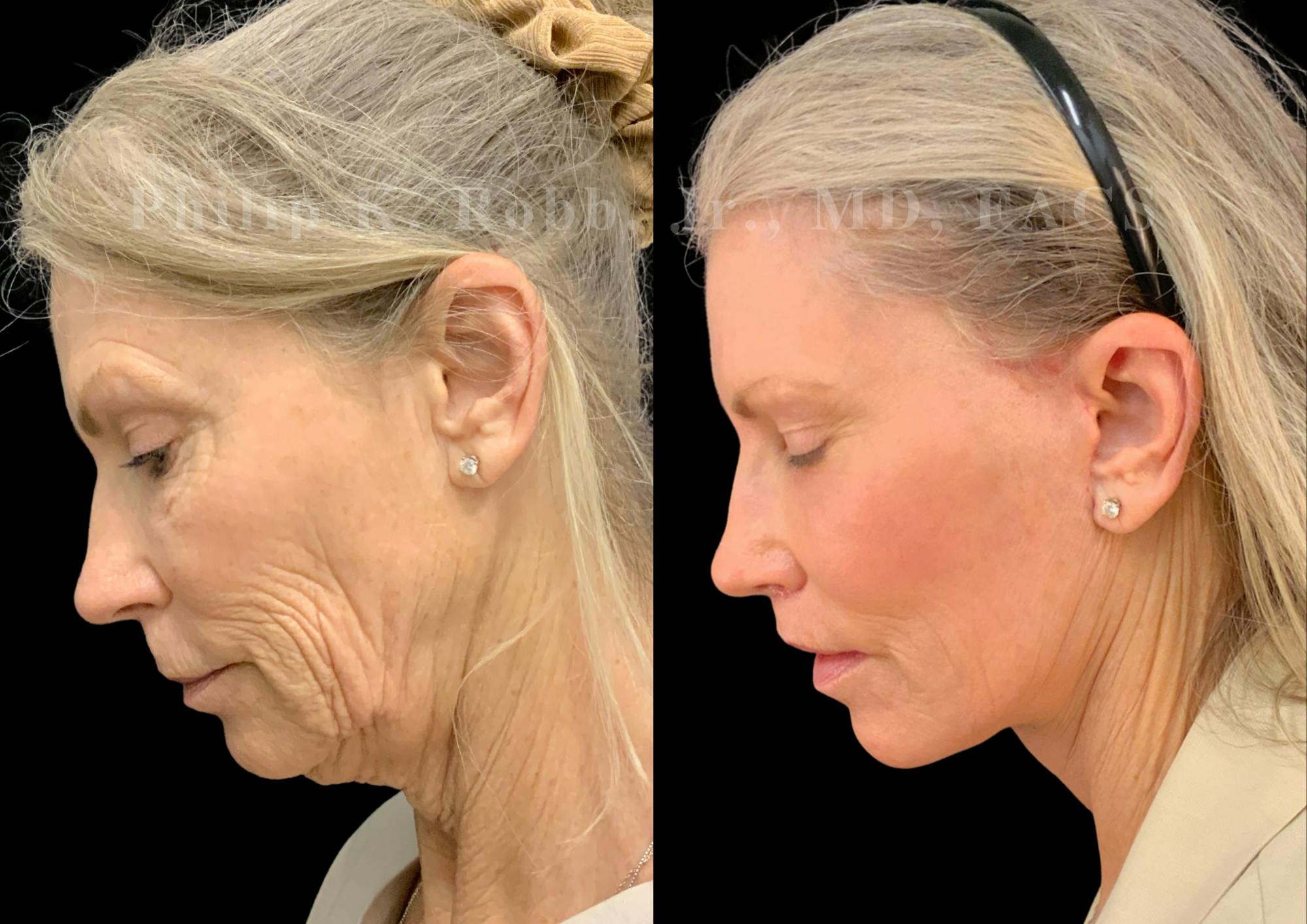 Laser Skin Resurfacing Before & After Gallery - Patient 547677 - Image 2