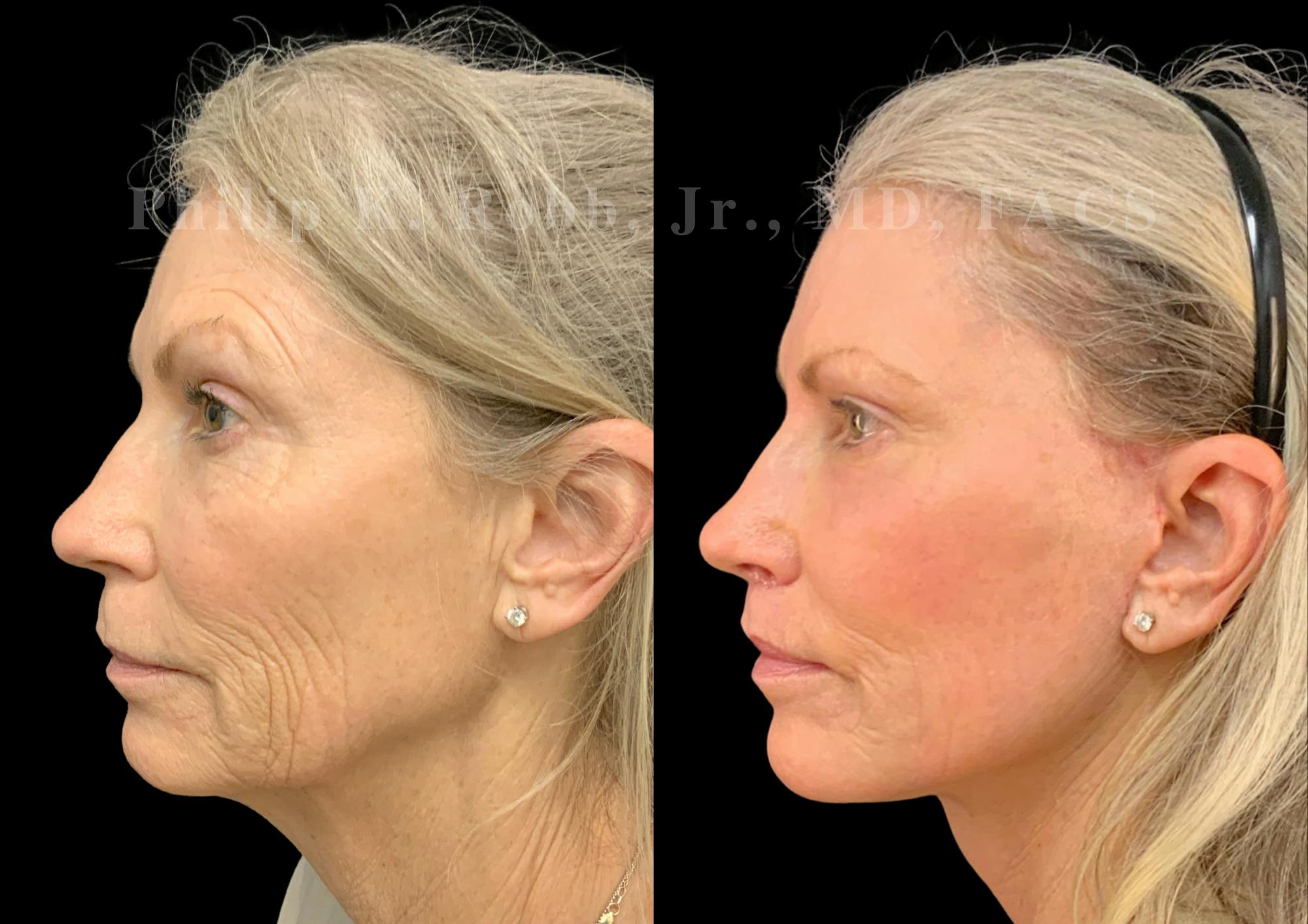 Laser Skin Resurfacing Before & After Gallery - Patient 547677 - Image 3