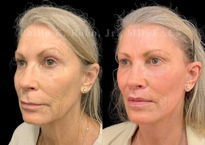 Facelift Before & After Gallery - Patient 435762 - Image 1