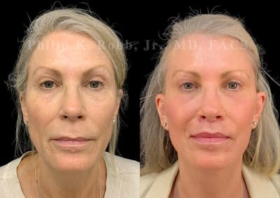 Laser Skin Resurfacing Before & After Gallery - Patient 547677 - Image 1