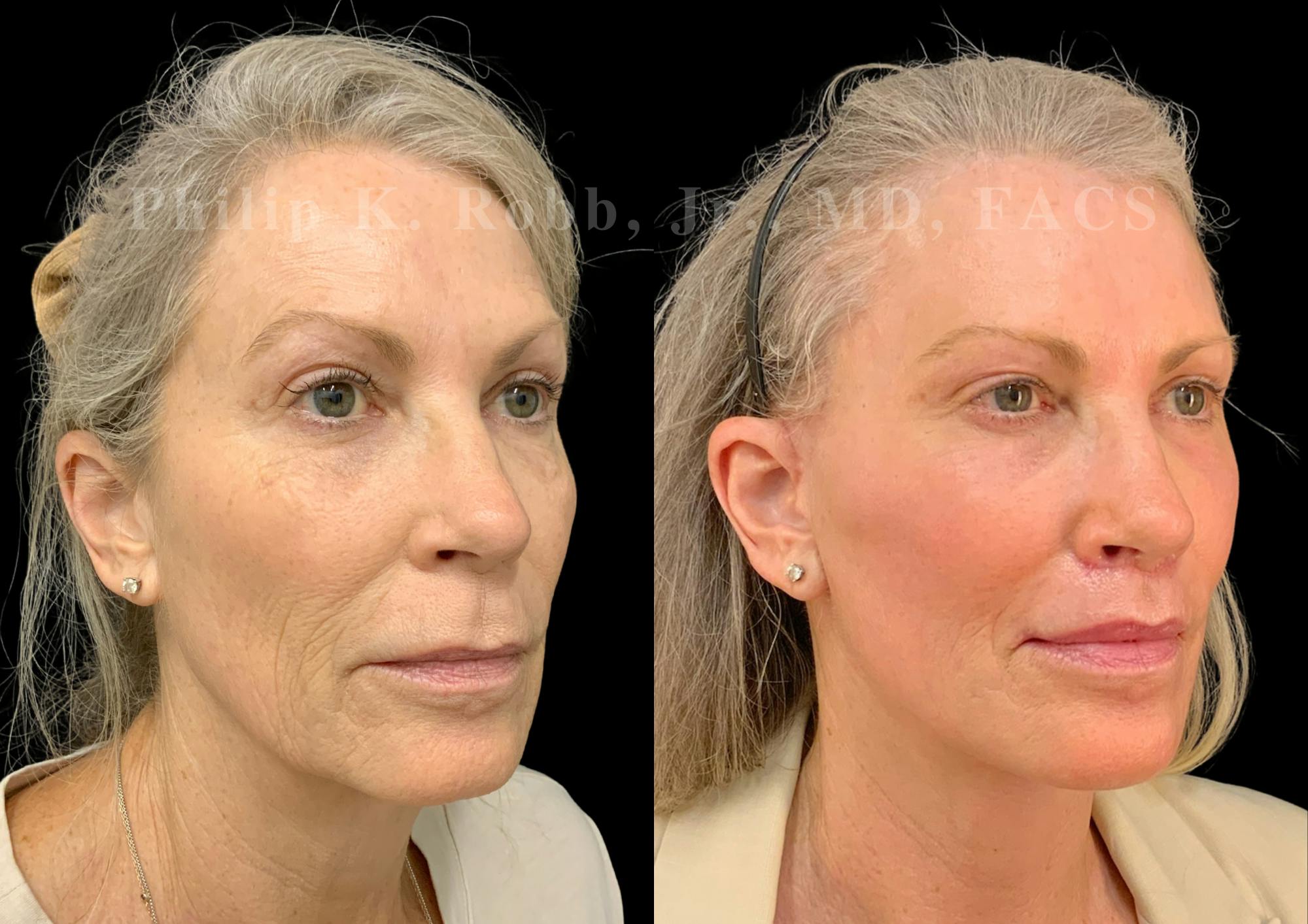 Laser Skin Resurfacing Before & After Gallery - Patient 547677 - Image 5