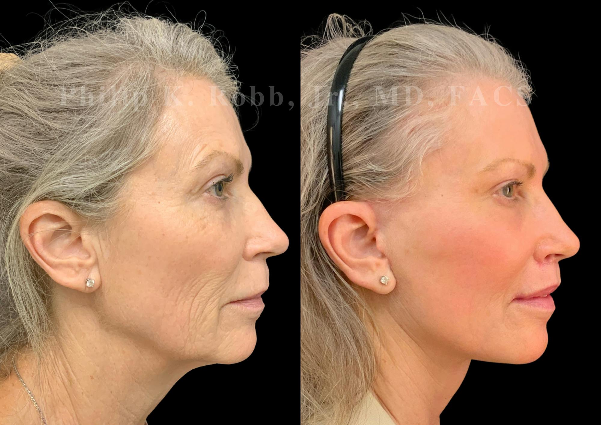 Laser Skin Resurfacing Before & After Gallery - Patient 547677 - Image 6
