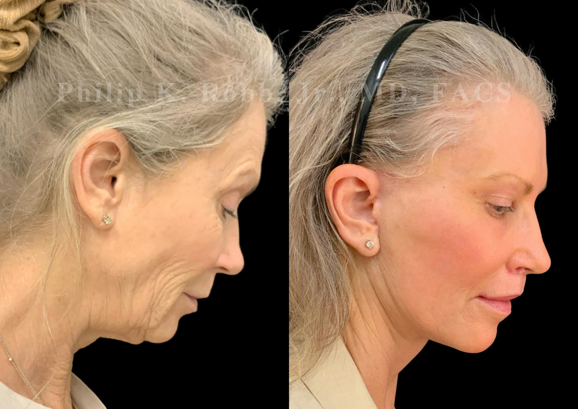 Laser Skin Resurfacing Before & After Gallery - Patient 547677 - Image 7