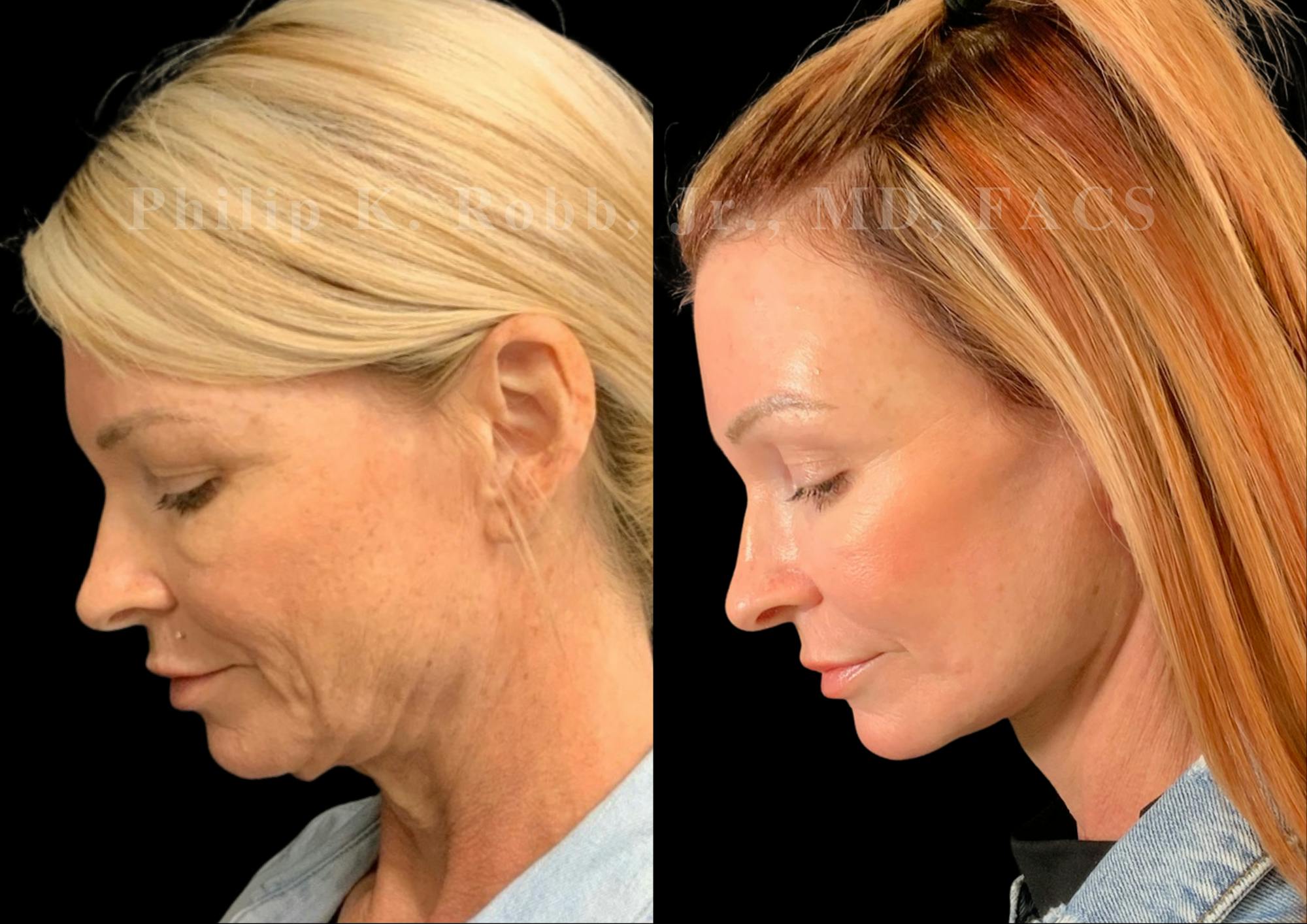 Laser Skin Resurfacing Before & After Gallery - Patient 404737 - Image 2
