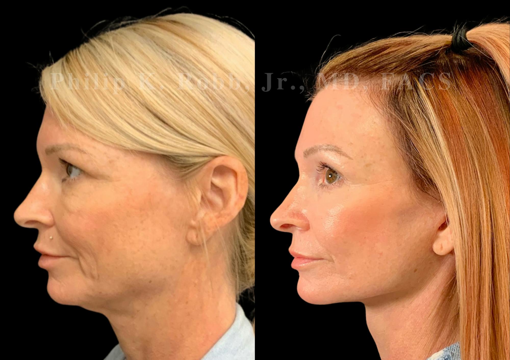 Laser Skin Resurfacing Before & After Gallery - Patient 404737 - Image 3