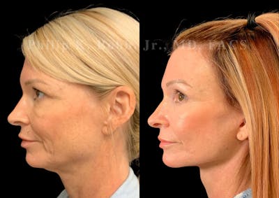 Neck Lift Before & After Gallery - Patient 582476 - Image 1