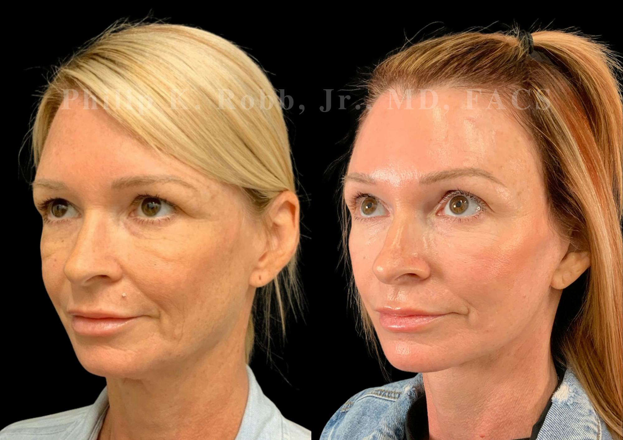 Laser Skin Resurfacing Before & After Gallery - Patient 404737 - Image 4