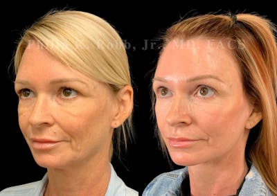 Facelift Before & After Gallery - Patient 298164 - Image 1