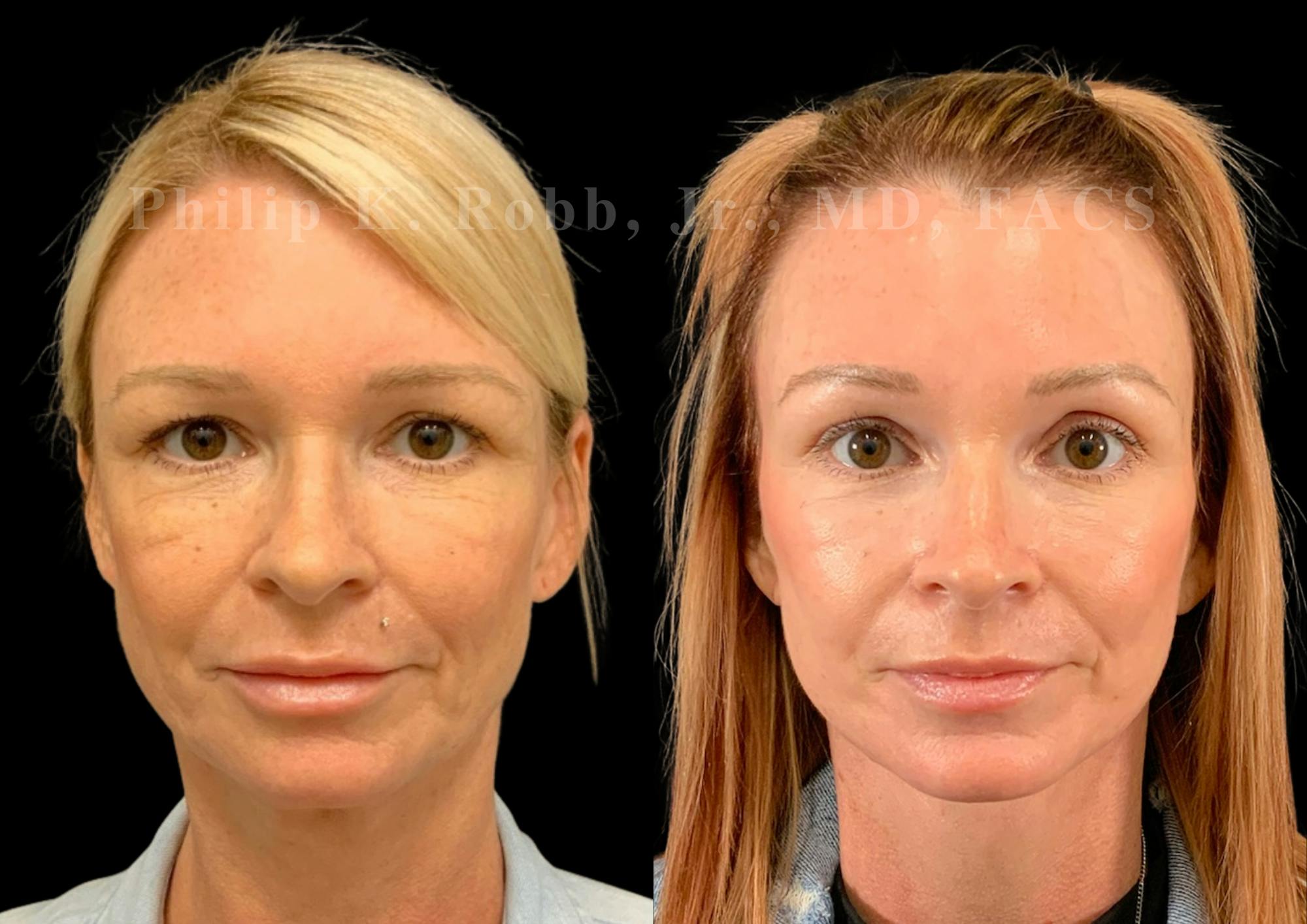 Laser Skin Resurfacing Before & After Gallery - Patient 404737 - Image 1