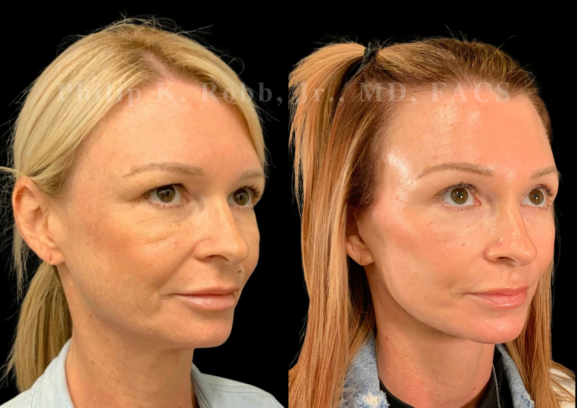 Laser Skin Resurfacing Before & After Gallery - Patient 404737 - Image 5